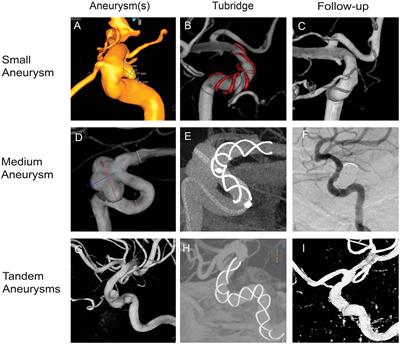 Tubridge flow diverter for the treatment of small and medium aneurysms